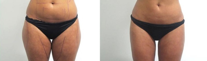 loss weight